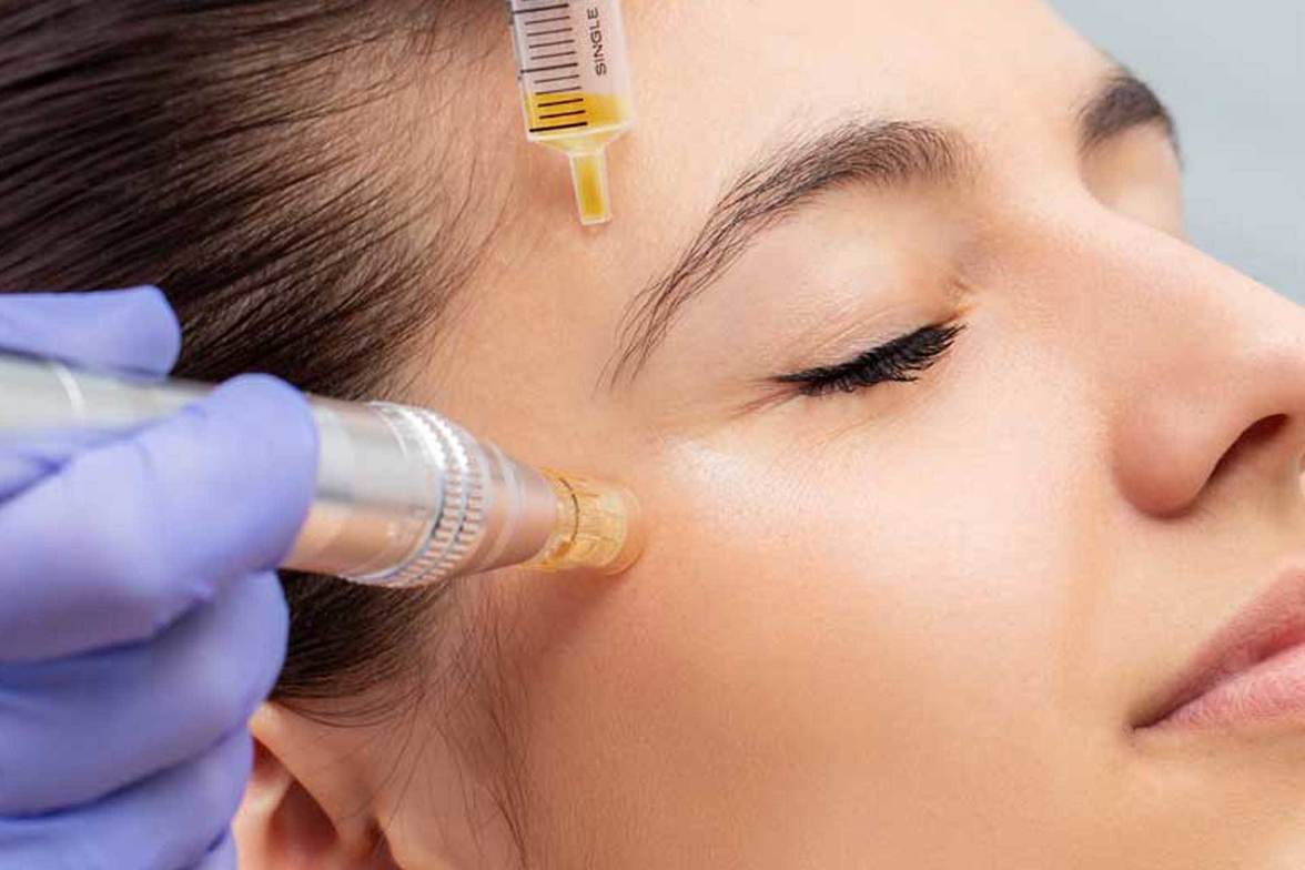 Microneedling, PRP y otras terapias anti-edad: beneficios, riesgos y tarifas en Perú