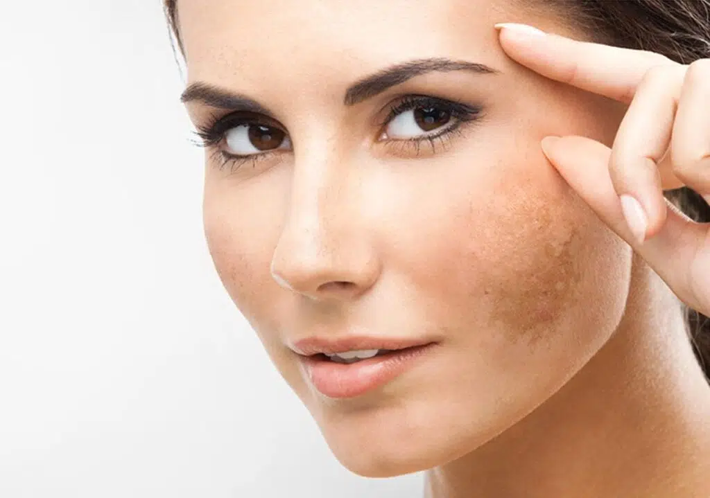 Mejores tratamientos para manchas en la piel : peeling, láser, micro-inyecciones